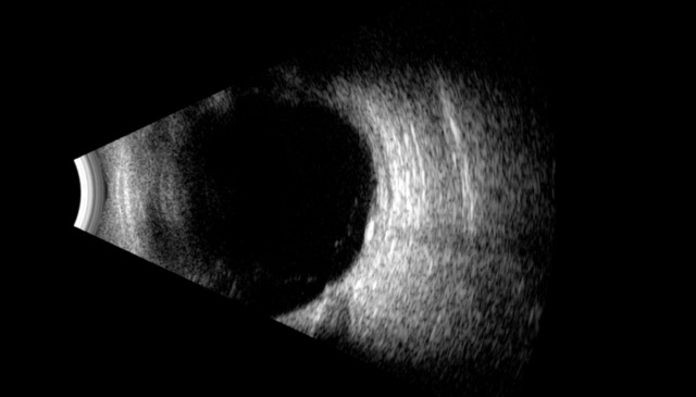 Figure 3: Longitudinal B-scan ocular ultrasound of the right eye at the 7 o�clock position demonstrating a small, localized calcified lesion inferotemporal to the nerve, corresponding to the focal scleral nodule.
